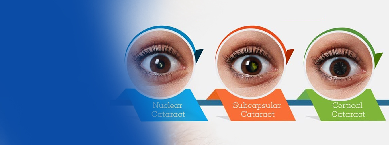 Cataract Specialist in Kolkata